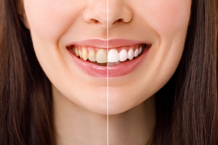 Smiling woman showing results of before and after teeth whitening procedure in Portage, MI