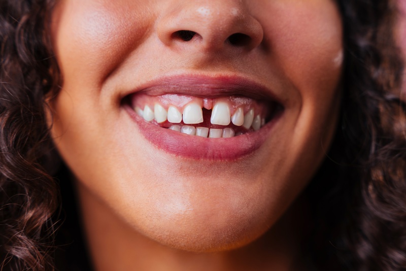 Beautiful young woman smiling before fixing space between her front teeth in Portage, MI